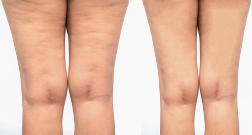 Cellfina® - Cellulite Treatment