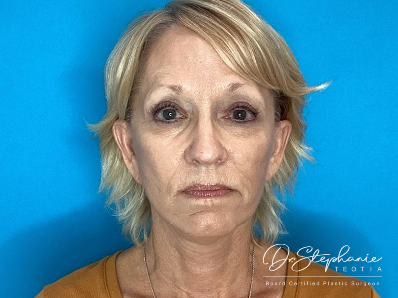 after facelift front view female patient case 4479