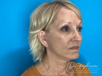 after facelift angle view female patient case 4479