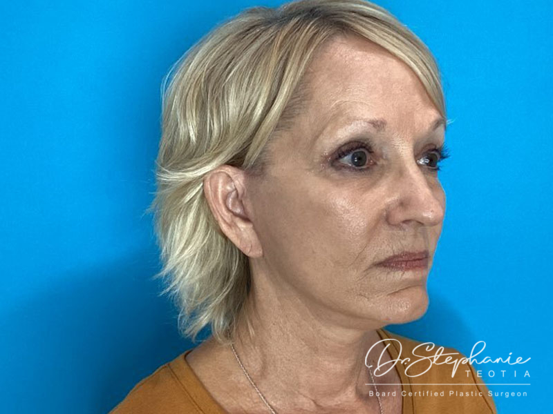 after facelift angle view female patient case 4479