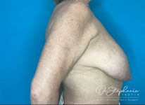 before breast reduction right side view female patient case 4530