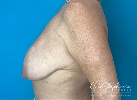 before breast reduction left side view female patient case 4530