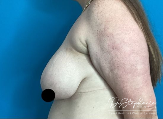 before breast reduction left side view female patient case 5198