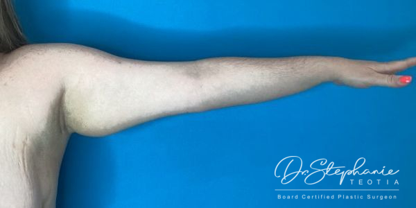 before arm liposuction left arm view female patient case 5207