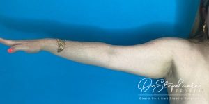 before arm liposuction right arm view female patient case 5207