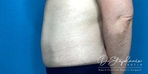 after abdominal liposuction side view female patient case 5212