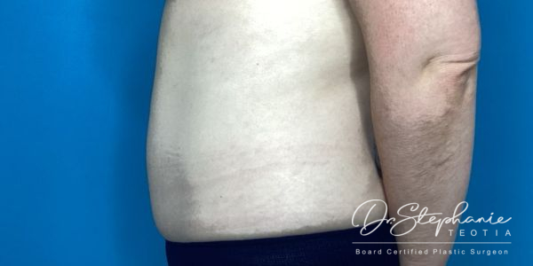 after abdominal liposuction side view female patient case 5212