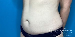 after abdominal liposuction angle view female patient case 5212