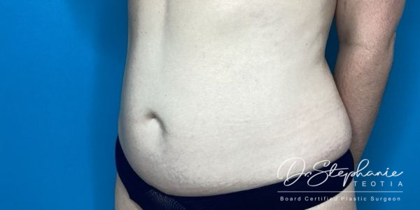 after abdominal liposuction angle view female patient case 5212
